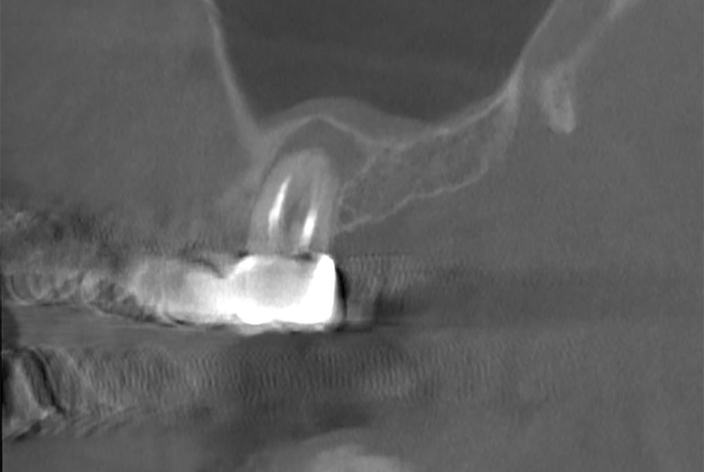 Erfahrungsbericht: Zahnrevision statt OP – Schwarzer Knoblauch zur Unterstützung der Regeneration